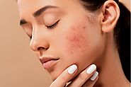 How Can I Permanently Get Rid of Acne - Health Tips