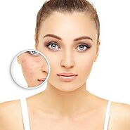 What is the Best Treatment for Acne Scars in Dubai | Enfield Clinic Dubai