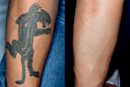 Website at https://www.dynamiclinic.com/side-effects-of-rejuvi-tattoo-removal/
