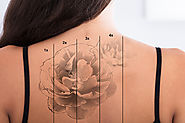 Website at https://www.dynamiclinic.com/laser-treatments/picosure-tattoo-removal/