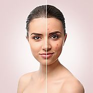 Website at https://www.dynamiclinic.com/laser-acne-scar-removal-cost-in-dubai/