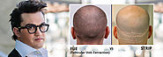 FUE Hair Transplant in Indore - Alvi Armani.