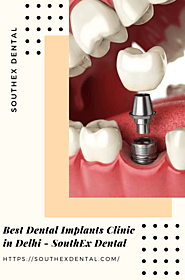 Best Dental Implants Clinic in Delhi - SouthEx Dental