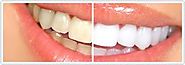 SouthEx Dental - Get White Clean Shiny Teeth