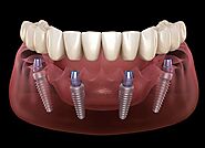 Durable Dental Implants in South Delhi - SouthEx Dental