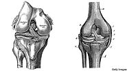Anterior cruciate ligament injuriesACL injuries are a growing problem