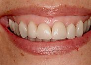 A Non-Surgical Solution for Gummy Smiles | PCE