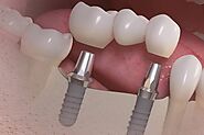 Looking for Same Day Dental Implants? | PCE