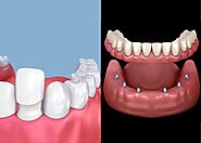 Dental Veneers vs. Dental Implants | PCE
