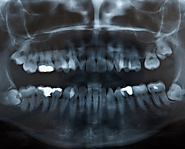 What Do You Need to Know About an Impacted Wisdom Tooth?