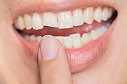 Tooth Fracture/Cracked Tooth: Causes, Diagnosis and Treatments