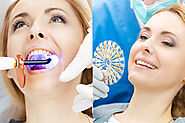 Why Should You Choose Professional Teeth Whitening