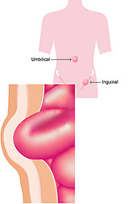 Best Hernia treatment and operation in surat at Excel Laparoscopy