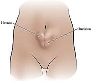 When do you need to undergo hernia operation or any procedure to treat hernia?