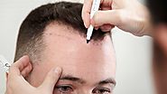 6 Steps to Reduce Risk of Infection after Hair Transplant
