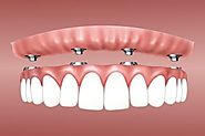 dental implants queens  - looking for a dental implant dentist in queens?
