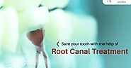 Root Canal Treatment in vasant vihar