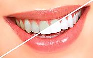 Teeth Whitening Services in Vasant Vihar - freeprachar.com