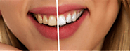 Find The Best Teeth Whitening in Croydon