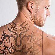 Picosure Laser Tattoo Removal in Dubai & Abu Dhabi | Enlighten PICO Cost