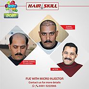 non surgical hair transplant in Lahore Archives - Hair Skills
