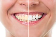 Lithia Dentist – Get the Benefits of Teeth Whitening Treatment