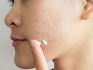 Types of Acne Scar Treatments that work – Laserskincareae