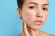 Best Acne Treatment For Sensitive Skin - Reaching World Live
