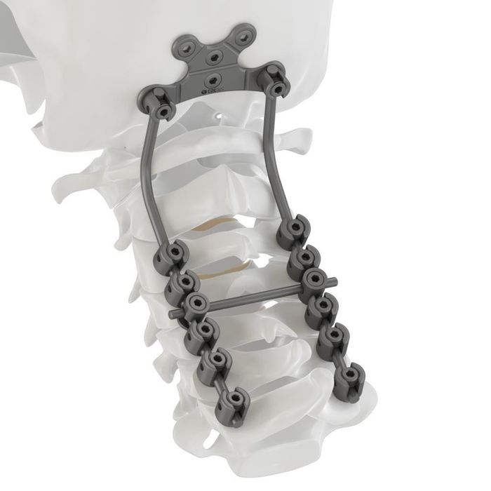 TILF Cage Back Surgery A Basic Documentary About The Back Surgery A