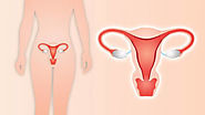 When is it recommended to have a Uterus Removed? - Altec Hospital