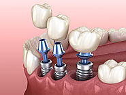 Why You Need To Consider Best Dental Implants in Kent?