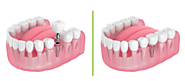 What is Dental Implants by Coast Dental Singapore