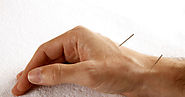 Acupuncture in Ahmedabad | Acupuncture Treatment in India