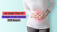 An Inside View Of Female Groin Hernia TEP Repair
