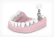 The Best Place to Get Immediate Dentures at King of Prussia, PA