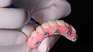 Our Dentists Can Create a Brand New Set of Permanent Implant Dentures in King of Prussia, PA