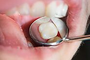 A filling is one way to repair a tooth damaged by decay.