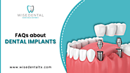 What Are the Benefits of Dental Implants?