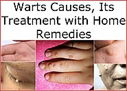 Warts Causes, Its Treatment with Home Remedies | Get Note IT