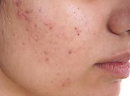 Pimples And Acne Causes, Treatment with Home Remedies | Get Note IT
