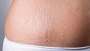 How To Clear Stretch Marks with Home Remedies | Get Note IT
