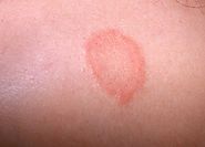 Ringworm Symptoms, Causes And Home Remedies | Get Note IT