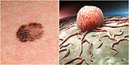 Melanoma Causes, Treatment with Home Remedies - Get Note IT