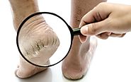 DIY Cracked Feet Home Remedies - Get Note IT