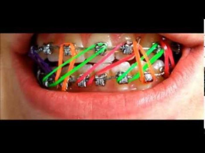 Orthodontic Braces Tips and Guides A Listly List
