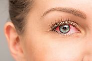 Apple Cider Vinegar For Pink Eye - Benefits, How To Use | How To Cure