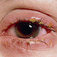 Blepharitis Symptoms & Treatment | Eye disease and home remedies
