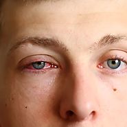 Care your Eyes | Conjunctivitis | Pink Eye