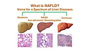 What is Non-Alcoholic Fatty Liver Disease (NAFLD)?