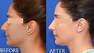 Different Techniques and Procedures of Rhinoplasty Nose Surgery